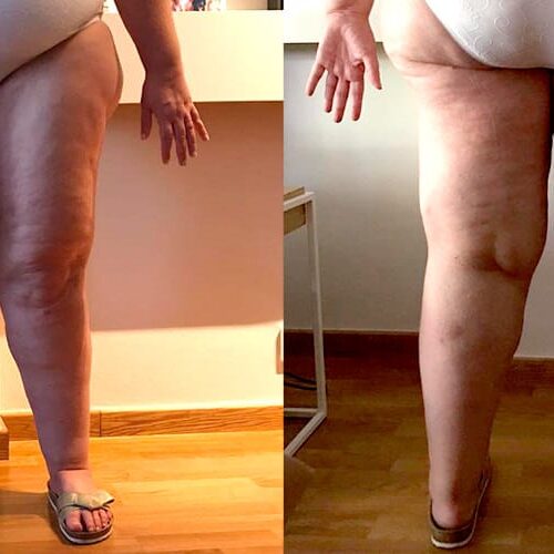 lipedema-tratamiento-fisioterapia